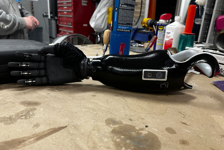 Arm Hand Prosthetics Washington Baltimore