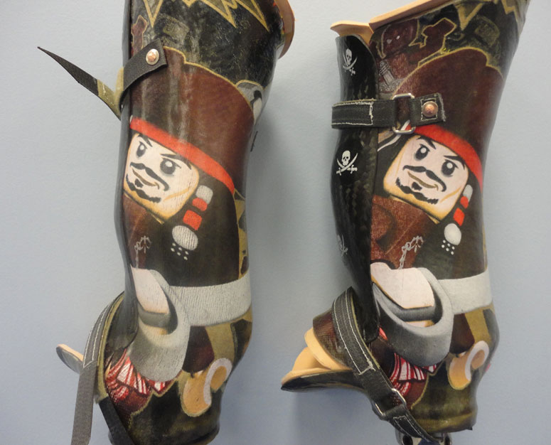 Prosthetic Sockets Washington Baltimore